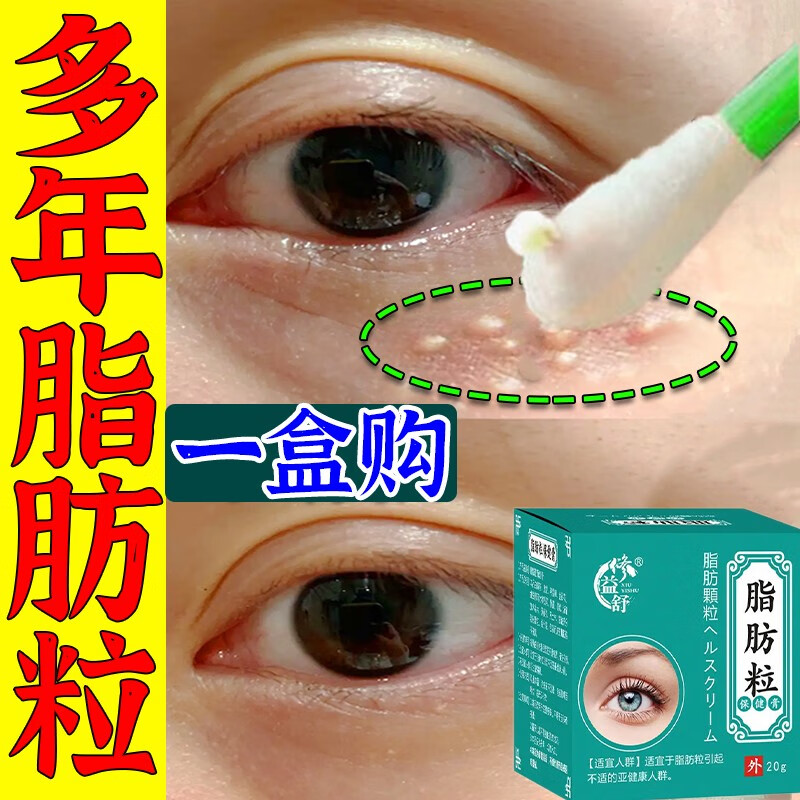 汗管瘤眼部去除汗管瘤专用膏脸黄疣去眼周油脂粒淡化黑眼圈专用膏脂肪