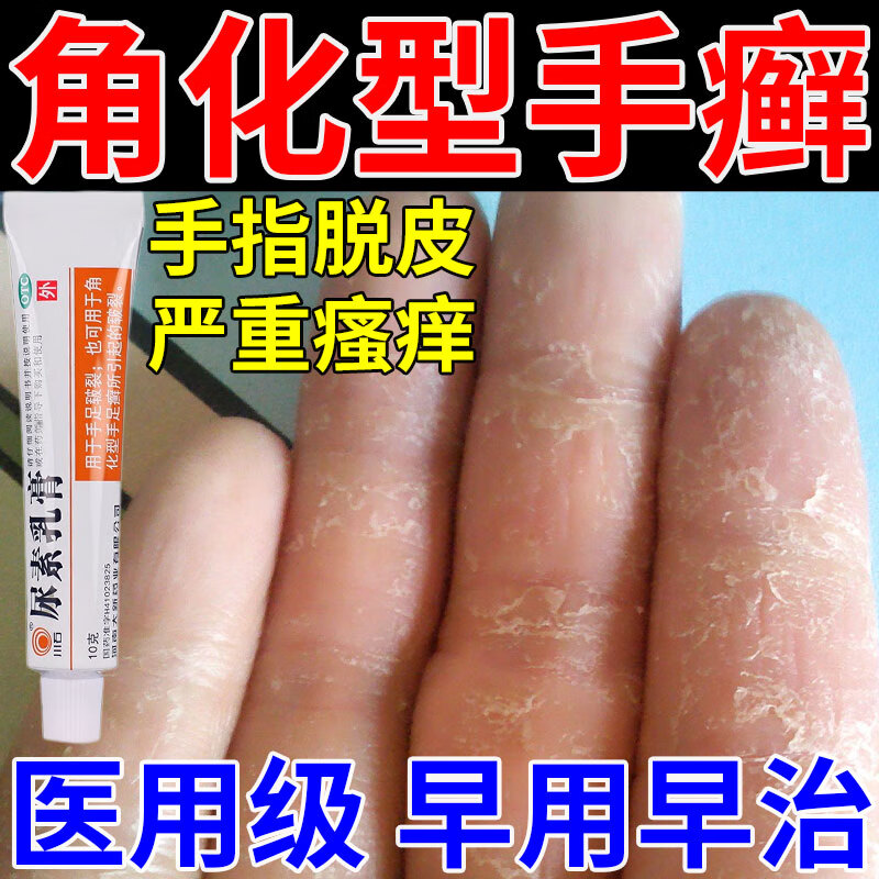 角化型手癣专用药】尿素乳膏 治手指关节癣手癣真菌感染手掌脱皮开裂