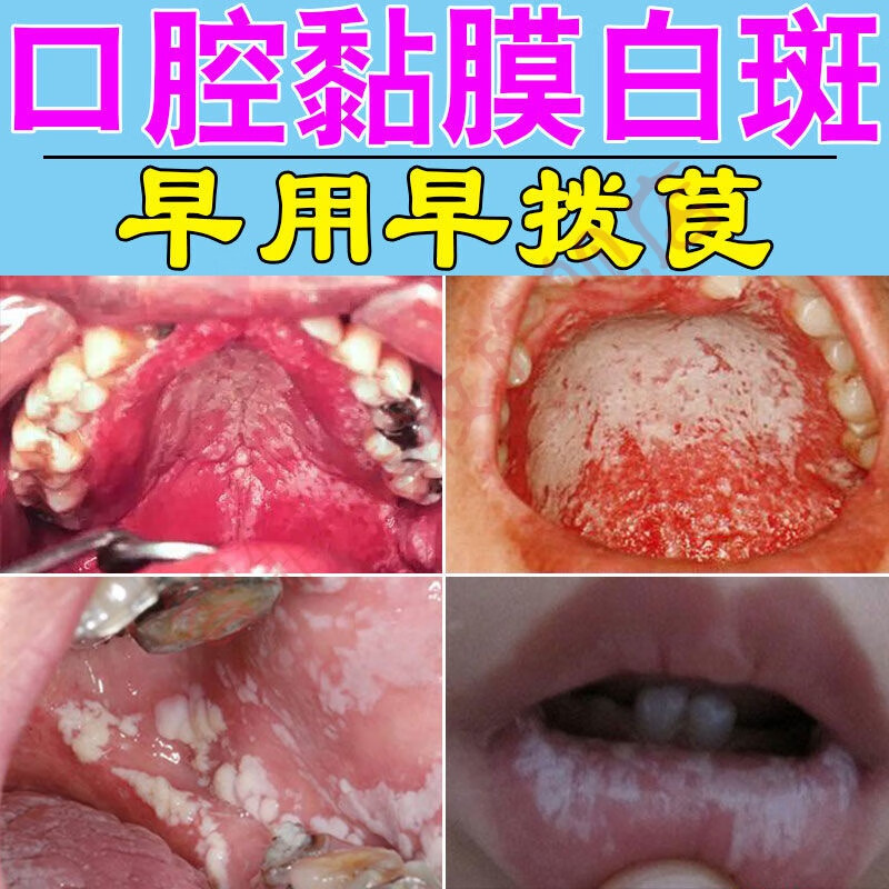 【一夜不见】口腔白色念珠菌感染上额红肿疼痛糜烂黏膜白斑液口腔护理