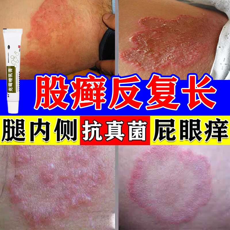 股癣专用药膏】治股藓药膏大腿内侧两侧长癣瘙痒发红潮湿闷热出汗红疹