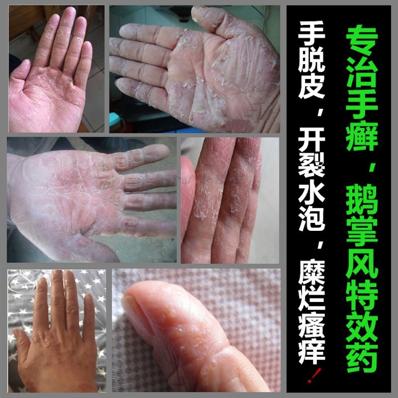 鹅掌风手脱皮干裂治手膏脱皮足的膏手水泡性兰恬纪