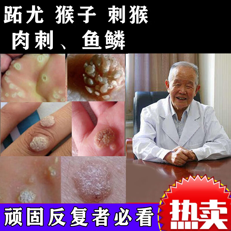 【京健康】子的药肉粒疙瘩鱼鳞痣休子点瘊子痦子肉刺去除手