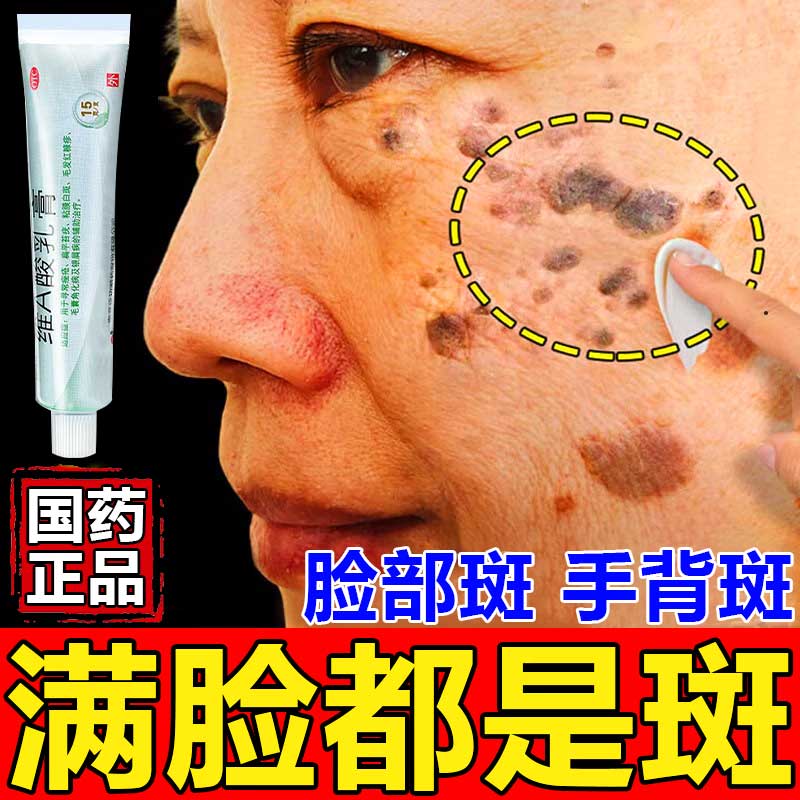 老年斑专用药祛斑专用药脸部 老年斑专用药脸部手背去黑色素沉着皮肤