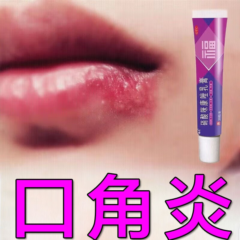 嘴角溃烂软膏口角炎烂嘴角药膏嘴唇干裂脱皮硝酸咪康唑乳膏 嘴巴上火