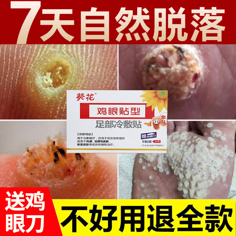 鸡眼贴去i根去肉刺去脚根跖疣肉瘊子手部足部脚底老茧肉刺走路疼下地