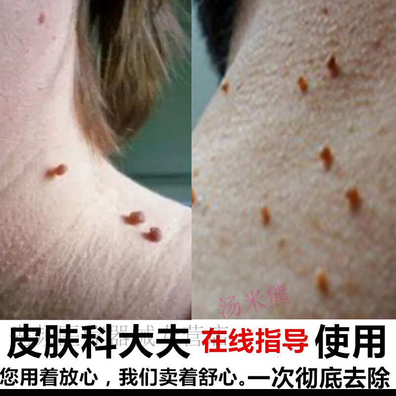 【jd健康】扁平疣面部专用 扁平疣去除膏面部瘊子丝状疣去除神器