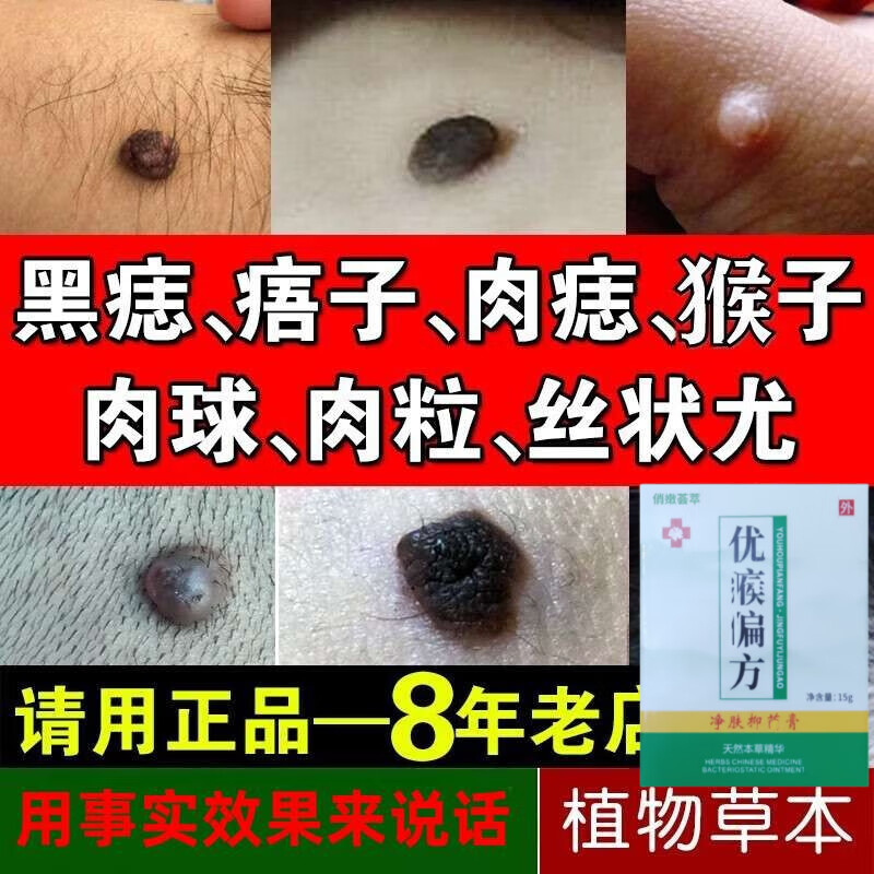 俏嫩荟萃痦子去除祛肉瘤皮赘去除膏猴子脖子上长的小肉粒疙瘩腋下凸痣