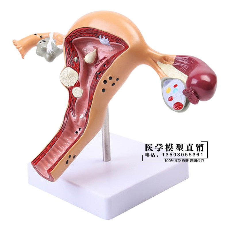 人体模型女性生殖子宫卵巢子宫教学模具病理变化科普培训