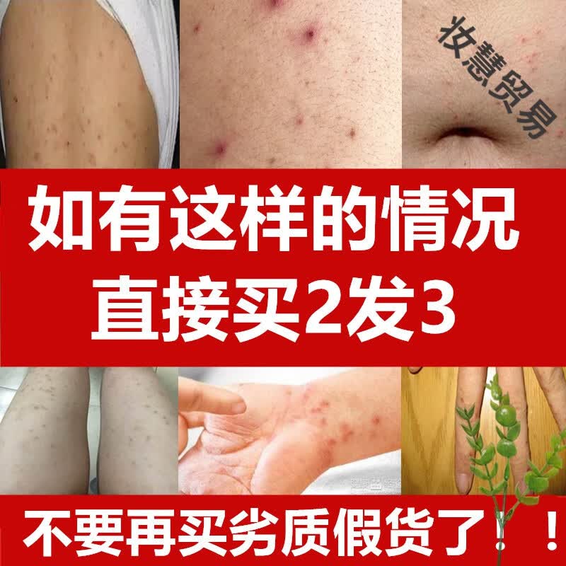 疥l疮膏阴囊结节箹止痒膏一扫光疥虫阴虱疥螨疥苍专用硫磺软膏儿童