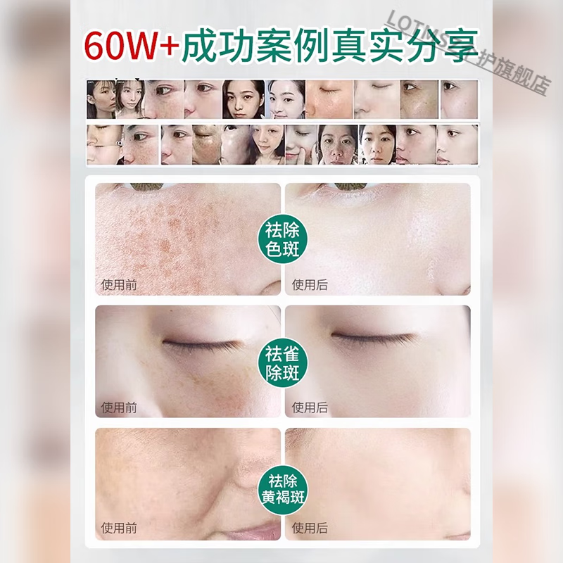 LQTMSZ纯中药霜祛斑早晚霜黄褐斑晒斑雀斑黑色素 三瓶巩固，拒绝反弹 纯中药霜