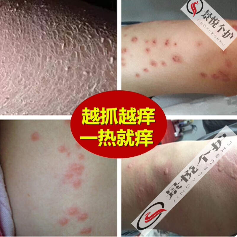 身上有红点皮肤瘙痒全身身上痒冬季皮肤瘙痒干燥起红疙瘩红点外用老年