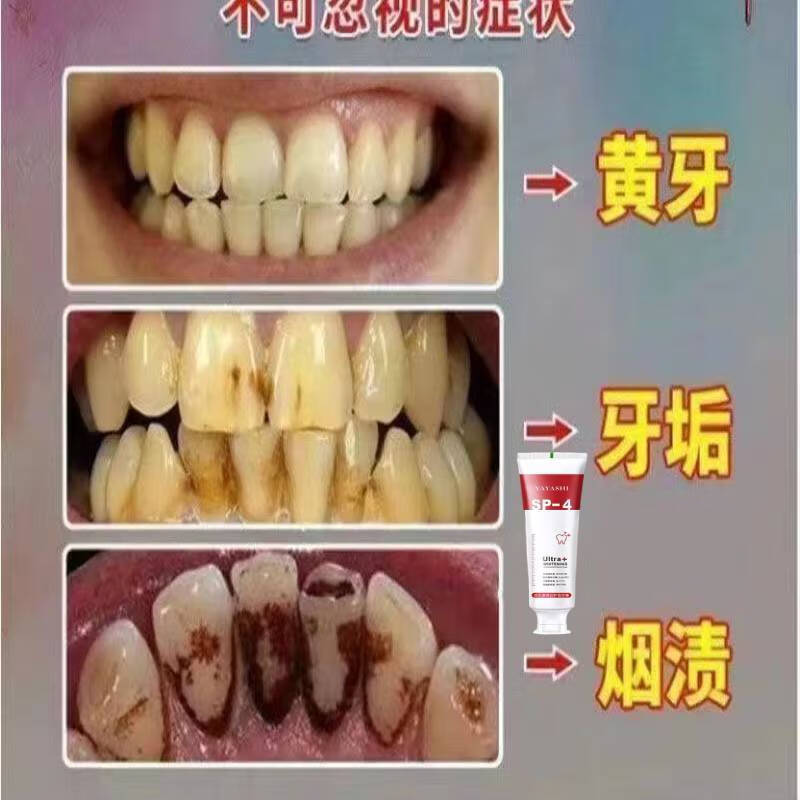 【药房直售】益生菌sp4亮白祛渍牙膏清新口气除渍增白渍大药房 重度