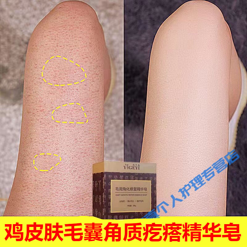 梵贞鸡皮肤鱼鳞皮肤霜干燥起皮杀菌清痘控油缓解鸡皮肤沐浴补水嫩