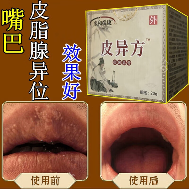【旗舰优选】皮脂腺异位贴异味嘴唇皮脂腺嘴角吧嘴唇皮脂腺异位症私处