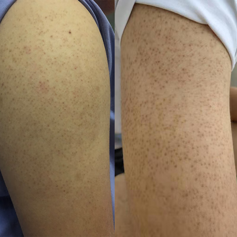 oeg南京祛鸡皮肤毛囊角质疙瘩大腿套装手臂身体乳精华液鱼鳞病果酸润