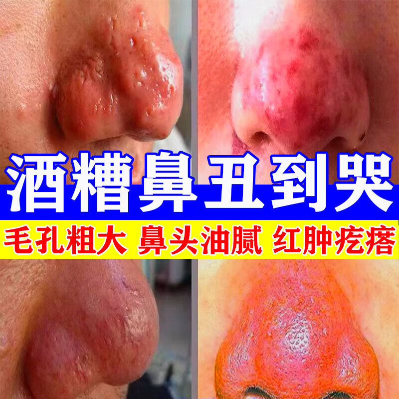 酒糟鼻专用药 草莓鼻红鼻子鼻根泛红治毛孔粗大红血丝螨虫鼻尖特红肿