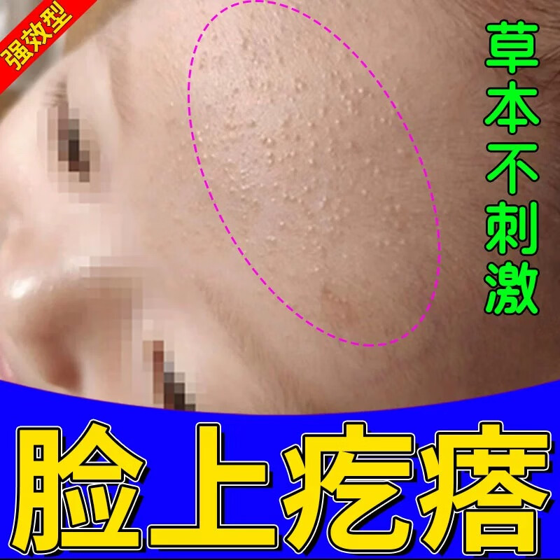 怀南堂逆光疹小孩脸上有小疙瘩小颗粒专用儿童起鸡皮疙瘩毛囊周角化