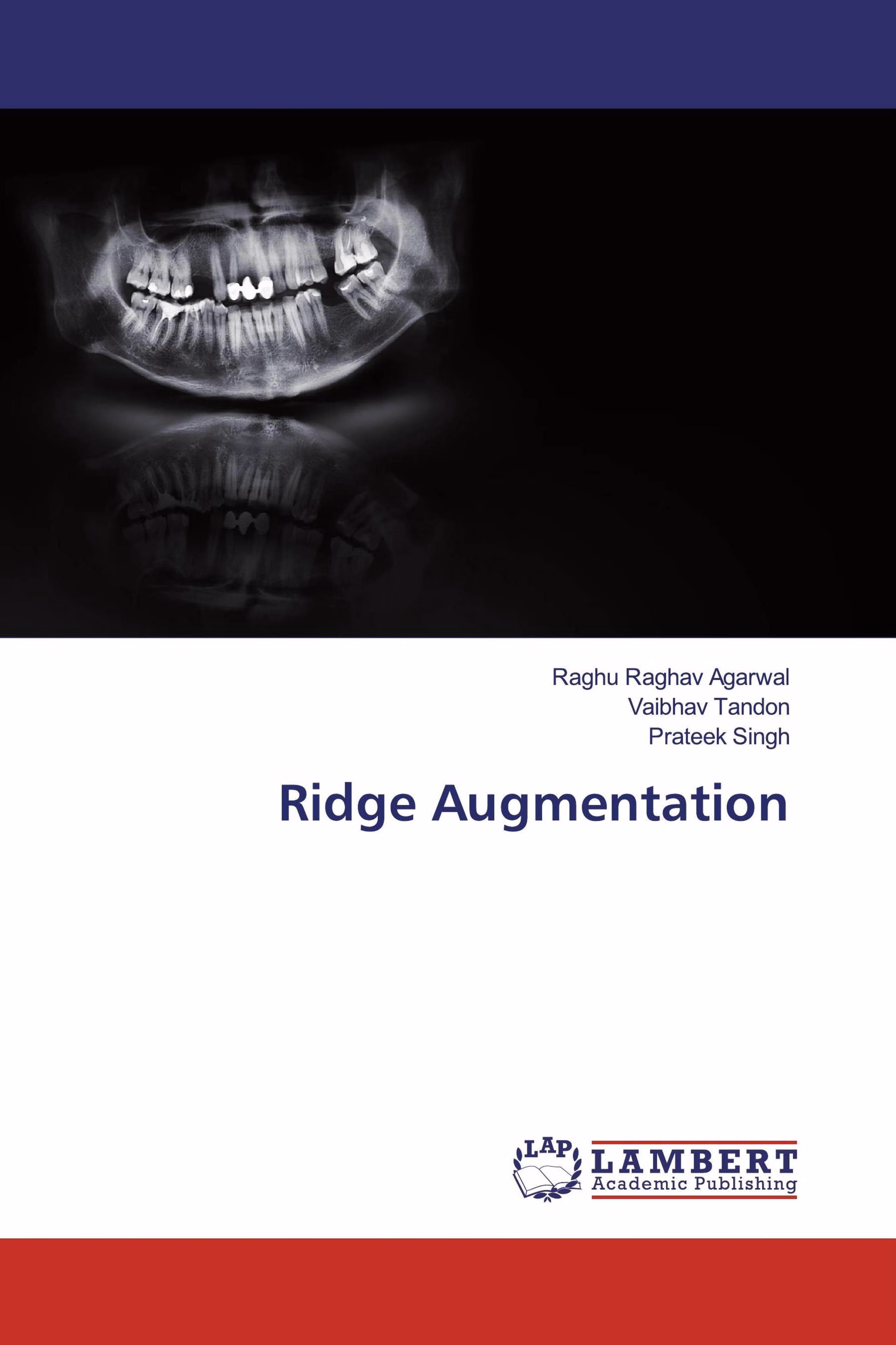 预订Ridge Augmentation