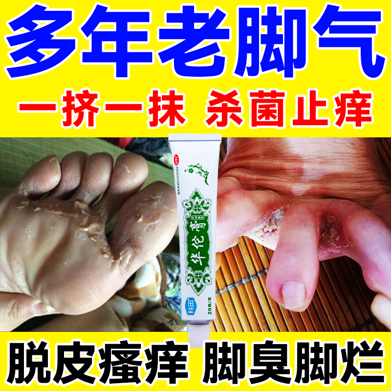 真菌感染的药止痒长水泡脱皮红肿烂脚丫真菌感染杀菌止痒治脚气华佗膏