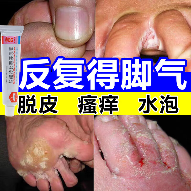 脚气脱皮烂脚丫脚痒杀菌止痒药膏 脚趾缝烂痒脚臭汗脚窝状角质松解症