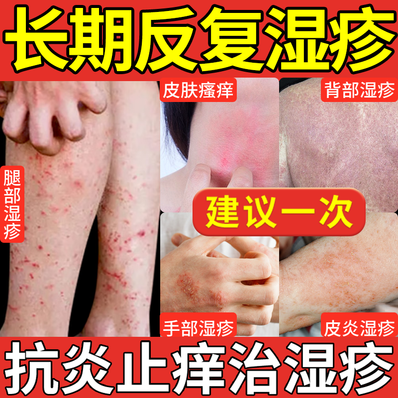 脂溢性皮炎湿疹药膏牛皮癣真菌感染断止痒膏皮肤瘙痒 皮肤瘙痒皮炎