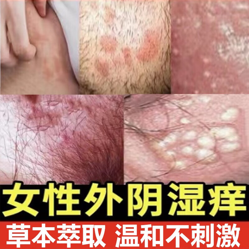 外阴私处瘙痒止痒膏外阴白斑瘙痒旗舰大腿内侧屁眼痒官方 一支装