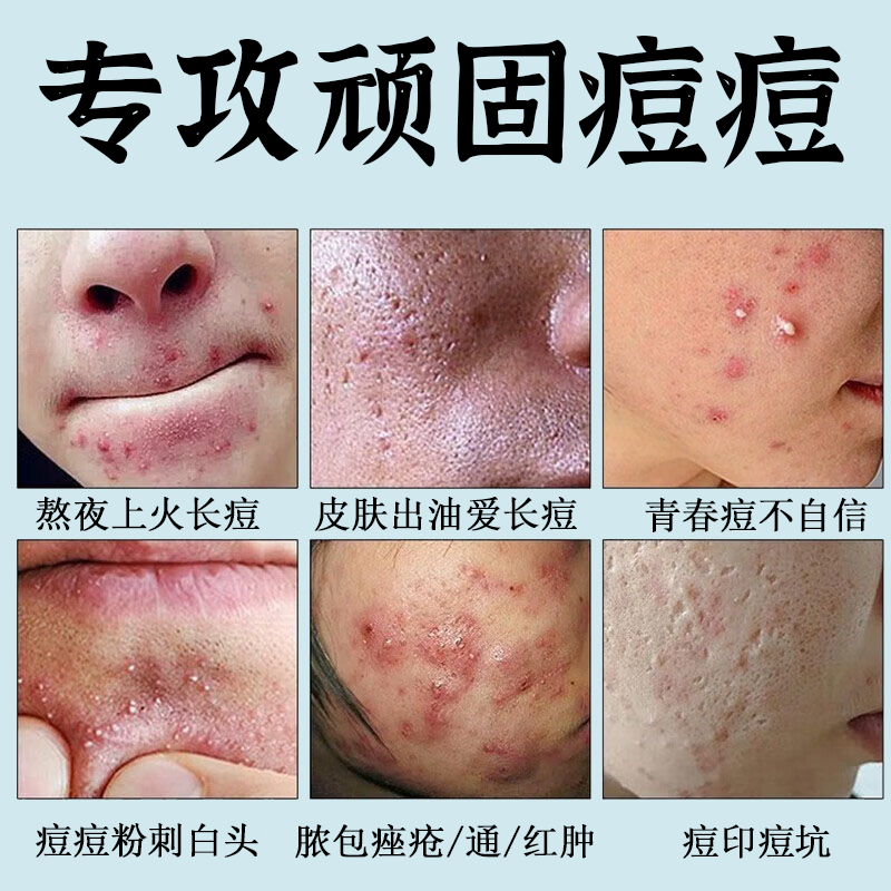 NHFOUYOU祛痘膏淡化痘印痘坑修复男女士改善粉刺闭口去痘痘和痘印 一盒【三盒一周期】买2盒 發3盒