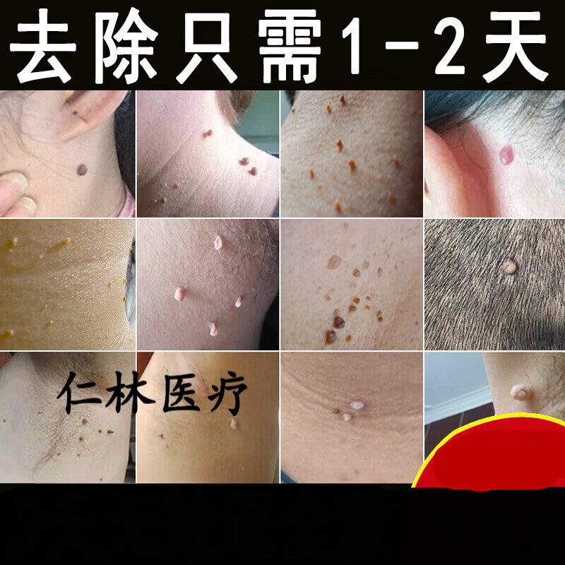 丝状疣脖子 颈部 脖子上小肉球肉粒肉刺疙瘩赘肉丝状疣瘊子去除腋