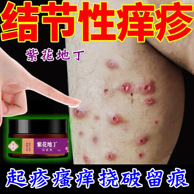 结节性痒疹特i效药治顽固硬疙瘩全身痒皮肤瘙痒红肿止i痒抑菌外用 买3