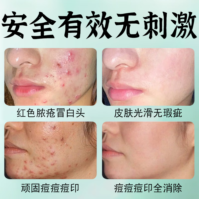 NHFOUYOU祛痘膏淡化痘印痘坑修复男女士改善粉刺闭口去痘痘和痘印 一盒【三盒一周期】买2盒 發3盒