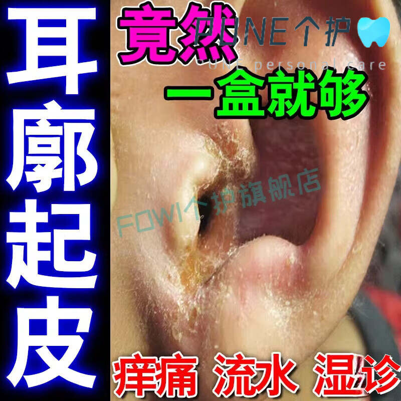 安奈雅耳朵真菌感染药治专外皮痒流脓皮肤瘙痒发炎祛湿药 一盒装