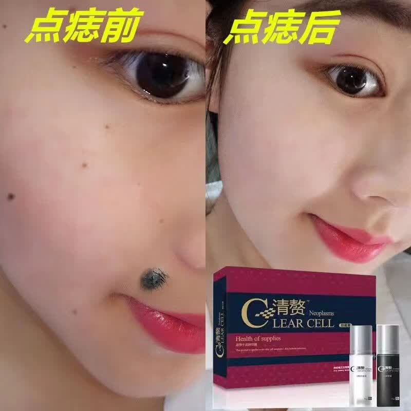 医美霖清赘点痣去痣膏点痣药水无痕脸部除痣灵平瘊膏點痦子面部套装点