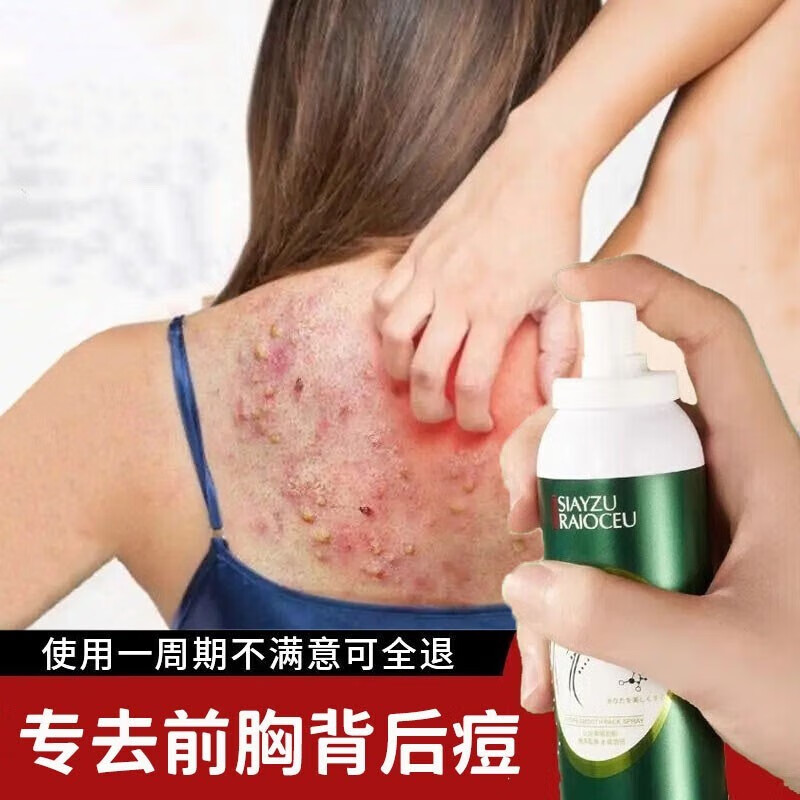 欣雅妆美背螨痘喷雾背部痘印粉刺后背红点背上长痘痘胸前喷雾男女 150