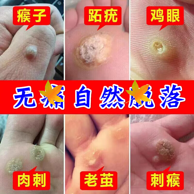 贴去脚根足部手部跖脚底疣脚垫祛茧膏去除子瘊刺肉疣寻常趾 鸡眼膏20g