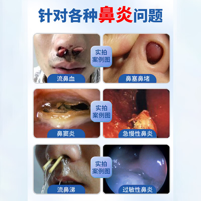 【大药房直售】伍医生鼻炎贴过敏性鼻炎鼻窦炎鼻塞通鼻器国药草本砭贴 伍医生鼻炎贴【1盒】店旗舰