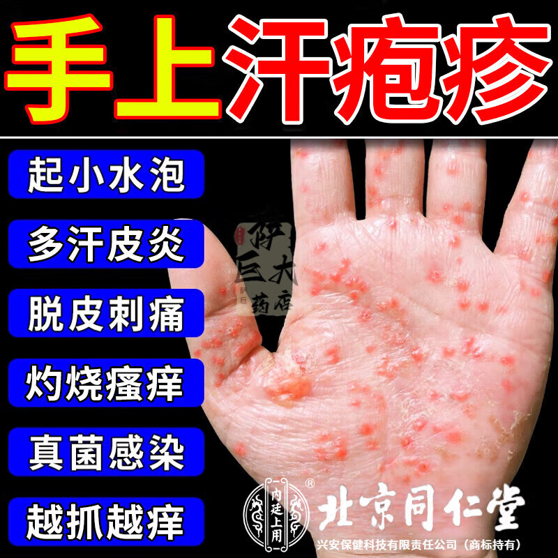 汗疱疹特痒效期3年医药凝胶手上痒起小水泡手干脱皮真菌感染手痒手指
