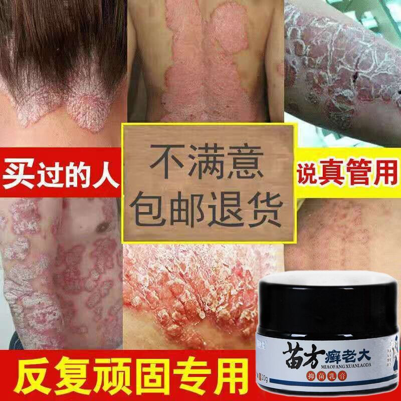 牛皮ii癣银i屑病膏顽固性皮ii癣体ii癣手足i癣皮肤瘙痒止痒专用老偏方