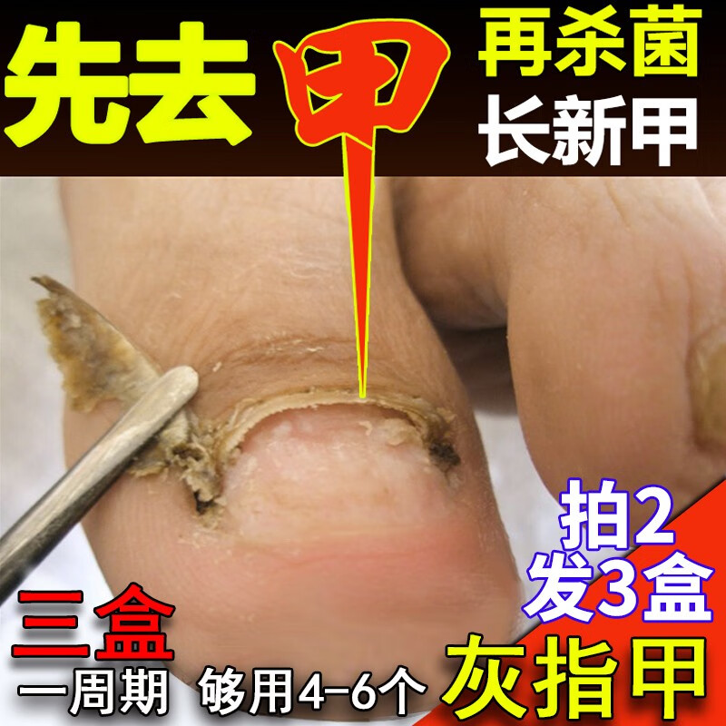 福美宜生灰指甲中草药增厚灰指甲脱甲液专用抑菌液软甲膏甲沟灰指甲液 灰指甲专用套盒