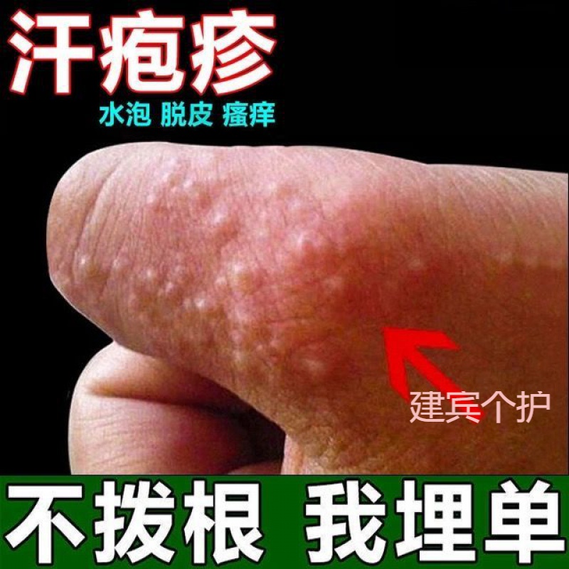 新品打折水泡疹手痒瘙痒汗l疱l疹手上小水泡起泡脱皮汗泡诊膏痒真菌