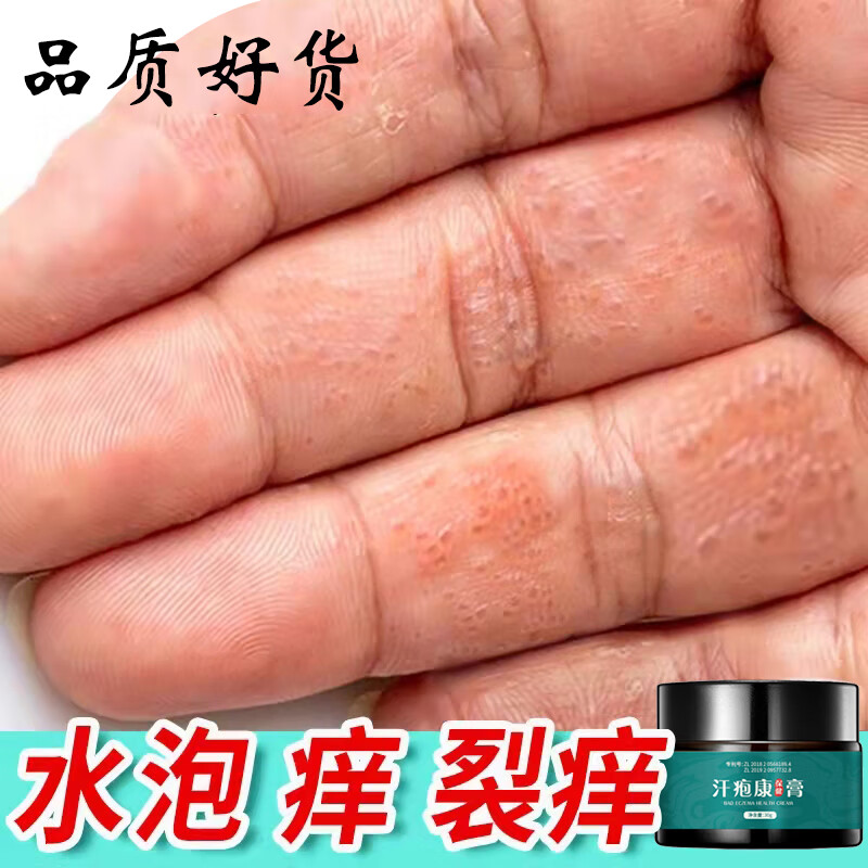 汗泡疱i疹药的膏手脚痒脱皮痒止膏死皮脚汗状痒止汉真菌感染汗泡疹 单
