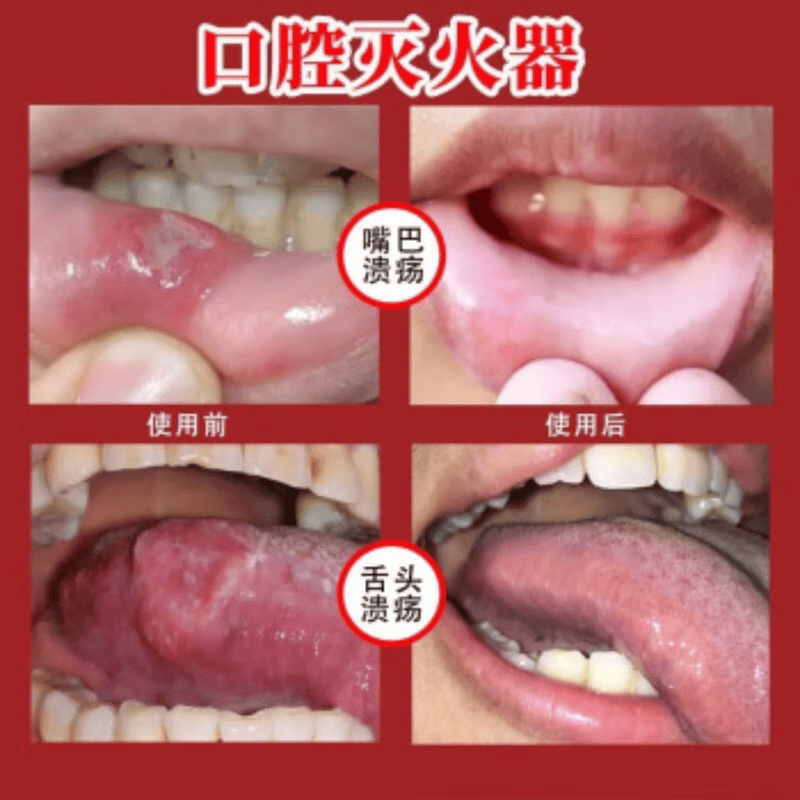 岩井晟弘制药日本口腔溃疡特专用的药喷剂凝胶嘴巴反复溃疡上火起泡口舌生疮 特价单盒装【特效喷剂】
