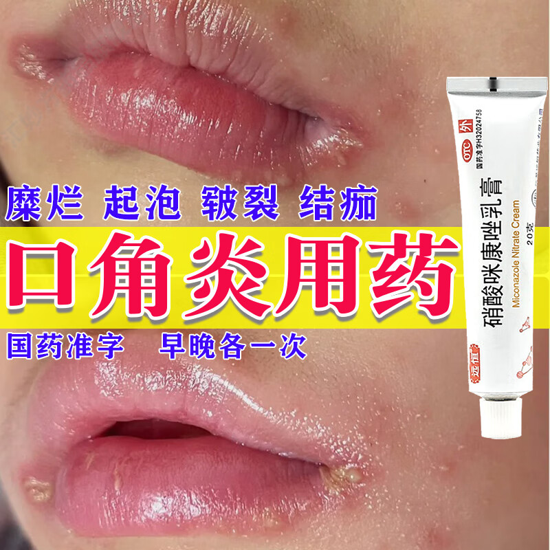 硝酸咪康唑乳膏 口角炎烂嘴角药膏儿童 嘴角开裂嘴角溃烂软膏口角炎