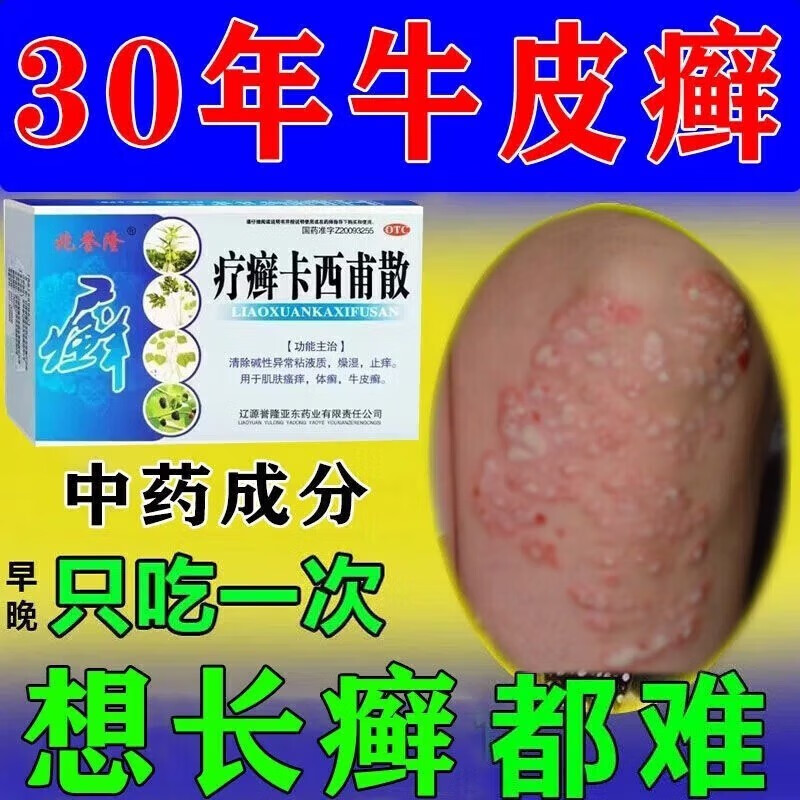 牛皮癣专用药治顽固银屑病治过敏性皮肤瘙痒斑驳起皮体癣红斑止痒脱屑