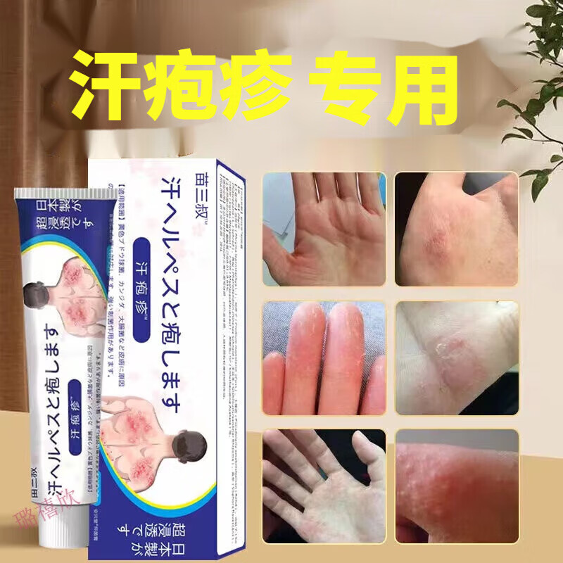 邹润安苗三叔手上起小水泡汗泡疹水泡疹手痒手瘙痒季节性手蜕皮皮肤