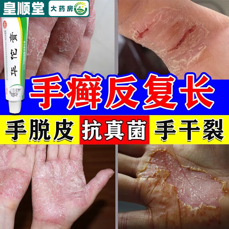 真菌感染专用药膏 鹅掌风手脱皮开裂干裂 手上起小水泡脱皮很痒 手指