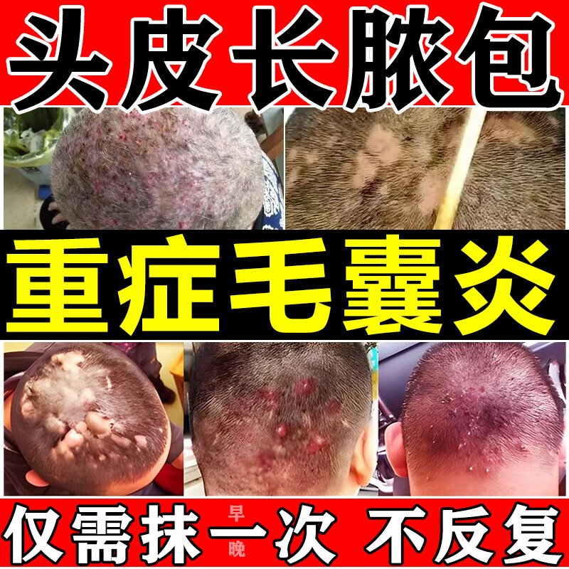 毛囊炎头部专用药毛囊炎药膏头皮痒有疙瘩发红头上长疙瘩脓包头皮专用