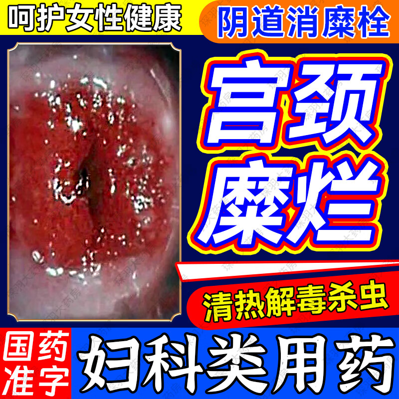 宫颈糜烂妇科用药二度三度消糜栓宫颈糜烂的药妇科消炎药 治多种妇科