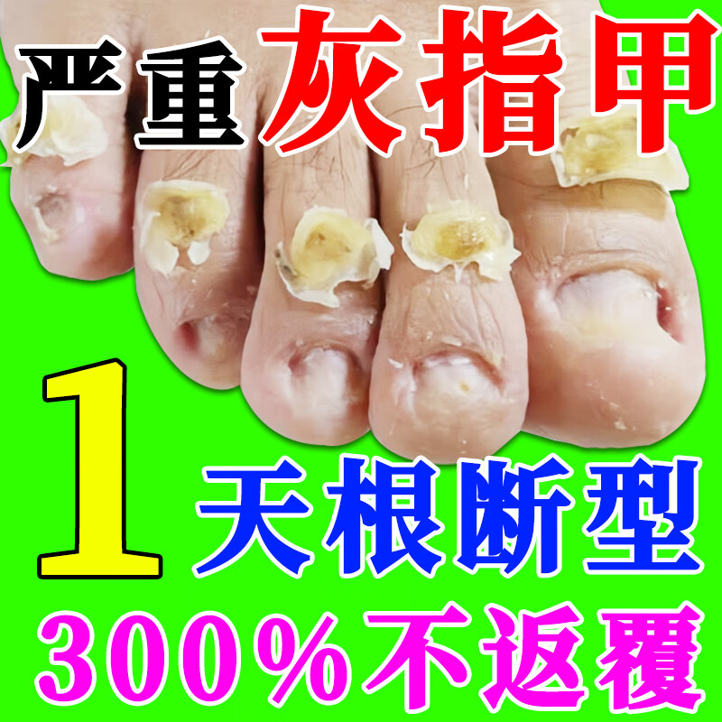灰指甲特傚效药指甲真菌感染脱甲坏甲脚指甲增厚去除裉治正药 一盒装