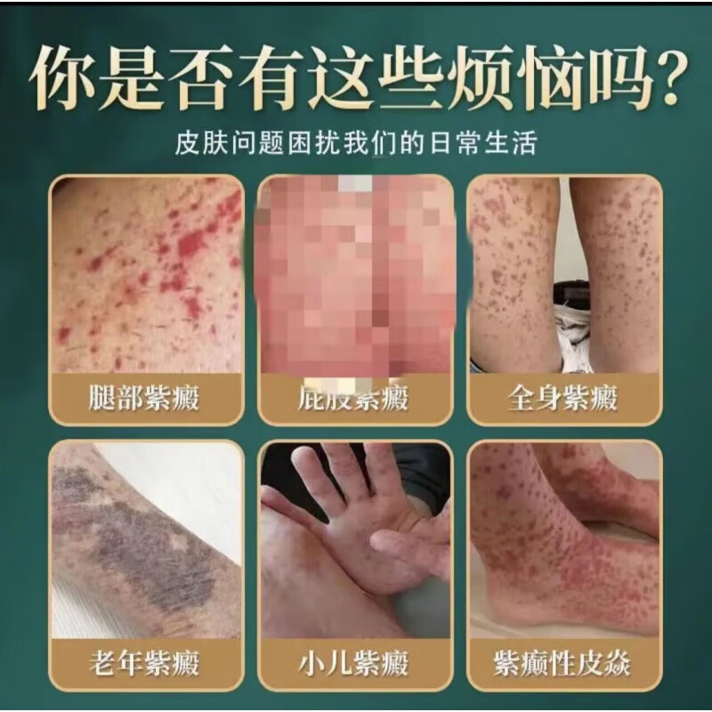 过敏性紫癜膏手脚长红点皮下出血小儿老年性皮下出血紫癜性 买3+2【五盒装】