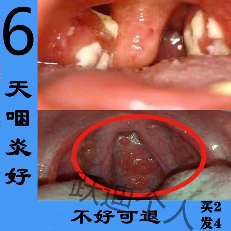 蜂胶咽喉滤泡喷剂喉咙肿痛嗓子干痒咳嗽有痰声带小结